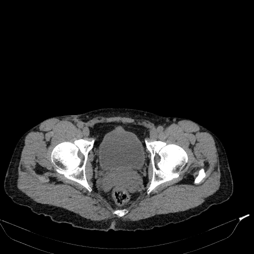 Aortic dissection - Stanford type A (Radiopaedia 83418-98500 Axial non-contrast 89).jpg