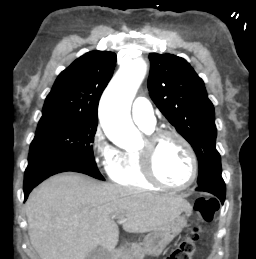 File:Aortic dissection - Stanford type B (Radiopaedia 50171-55512 B 27).png