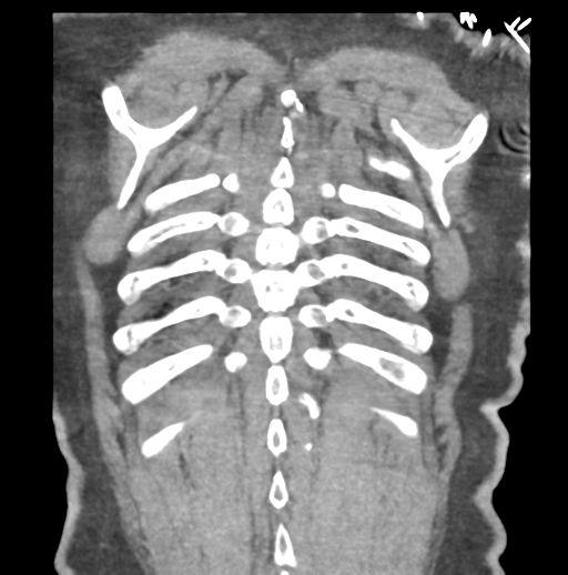 File:Aortic dissection - Stanford type B (Radiopaedia 50171-55512 B 77).png