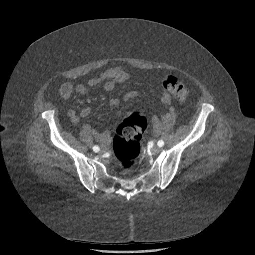 Aortic dissection - Stanford type B (Radiopaedia 88281-104910 A 144).jpg