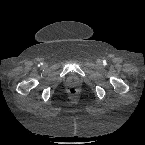 Aortic dissection - Stanford type B (Radiopaedia 88281-104910 A 163).jpg