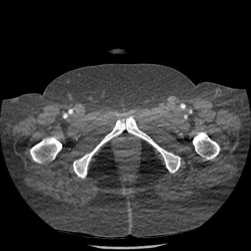Aortic dissection - Stanford type B (Radiopaedia 88281-104910 A 166).jpg