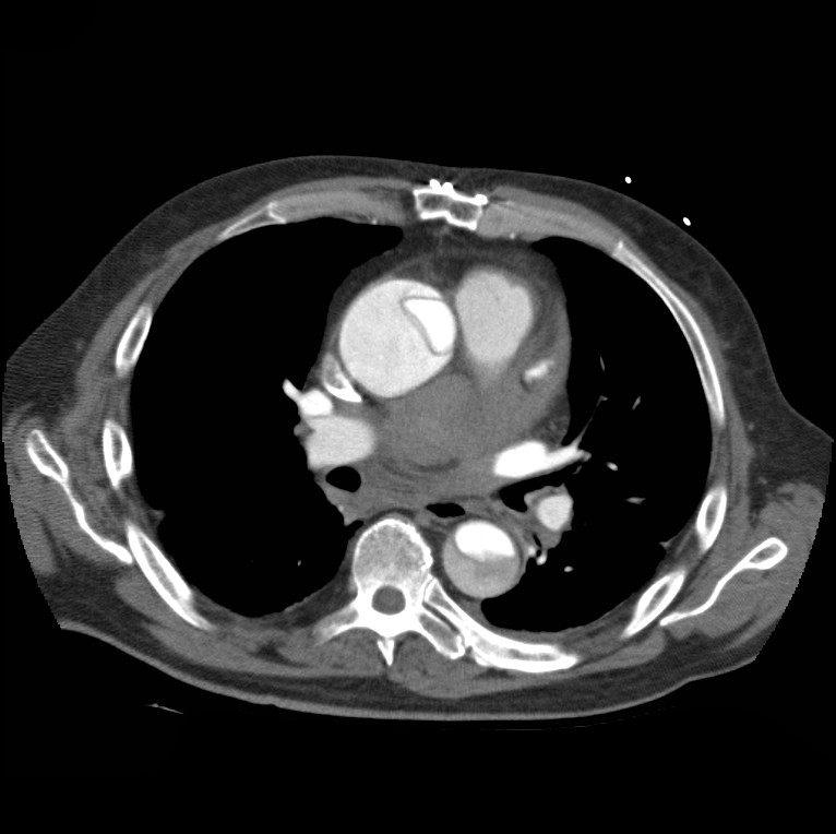 Aortic dissection with rupture into pericardium (Radiopaedia 12384-12647 A 27).jpg