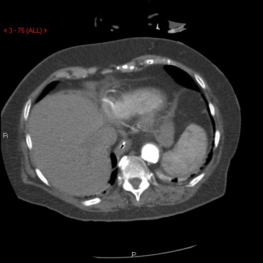 Aortic intramural hematoma (Radiopaedia 27746-28001 A 75).jpg