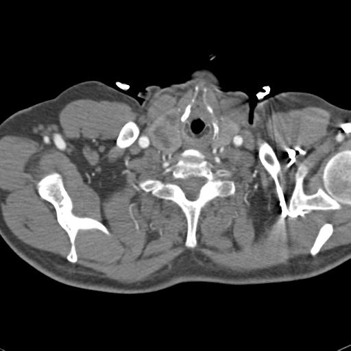 Aortic intramural hematoma (Radiopaedia 31139-31838 B 3).jpg