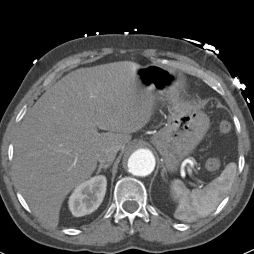 File:Aortic intramural hematoma (Radiopaedia 31139-31838 B 80).jpg