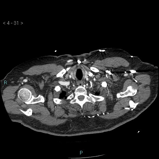 File:Aortic intramural hematoma (Radiopaedia 48463-53380 B 15).jpg
