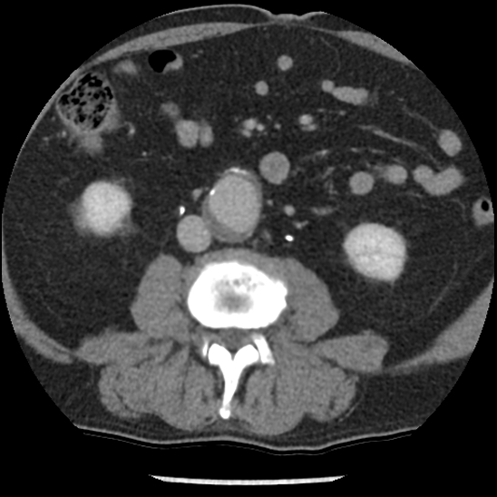 Aortic intramural hematoma (type B) (Radiopaedia 79323-92387 Axial C+ delayed 77).jpg