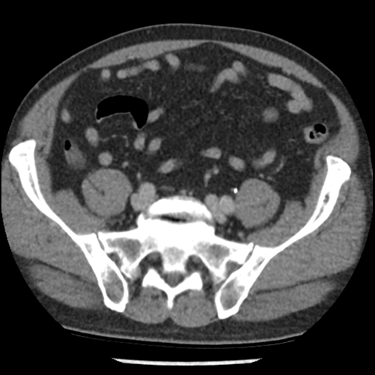 Aortic intramural hematoma (type B) (Radiopaedia 79323-92387 Axial C+ delayed 92).jpg