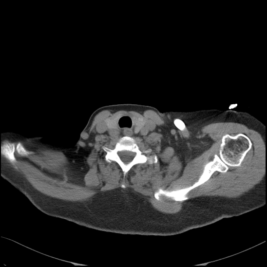 Aortic intramural hematoma with dissection and intramural blood pool (Radiopaedia 77373-89491 Axial non-contrast 7).jpg