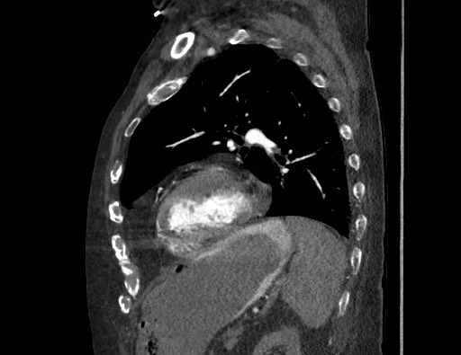 File:Aortoesophageal fistula with endovascular repair (Radiopaedia 73781-84592 Sagittal C+ CTPA 139).jpg