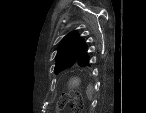Aortoesophageal fistula with endovascular repair (Radiopaedia 73781-84592 Sagittal C+ CTPA 177).jpg
