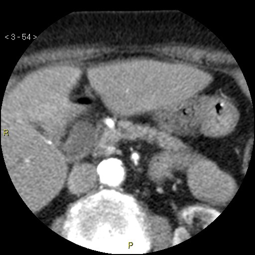 File:Aortoiliac occlusive disease (Radiopaedia 16828-16548 A 54).jpg