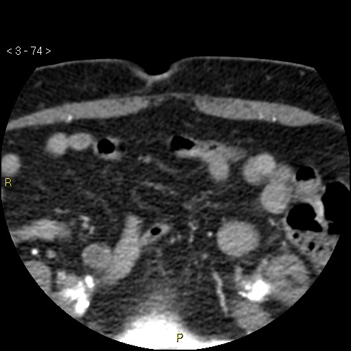 File:Aortoiliac occlusive disease (Radiopaedia 16828-16548 A 74).jpg