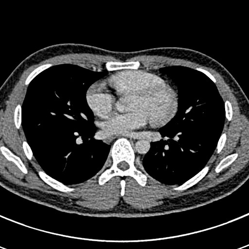 File:Apical lung mass mimic - neurogenic tumor (Radiopaedia 59918-67521 A 46).jpg