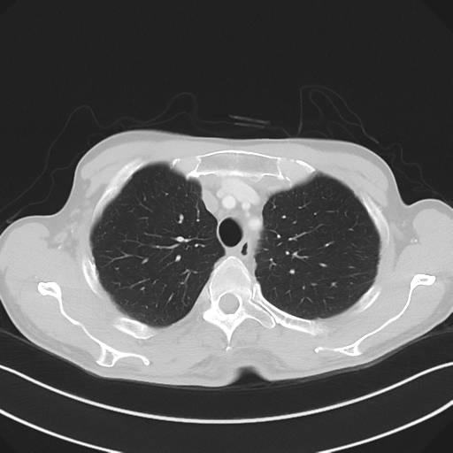 Apical pleural calcification (Radiopaedia 46141-50499 Axial lung window 17).png