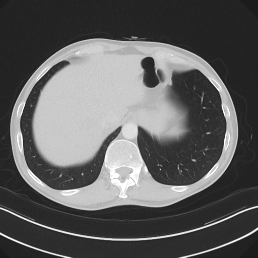 Apical pleural calcification (Radiopaedia 46141-50499 Axial lung window 61).png
