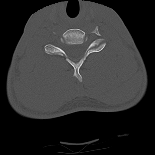 Apical pneumothorax on cervical spine CT (Radiopaedia 45343-49368 Axial bone window 63).jpg