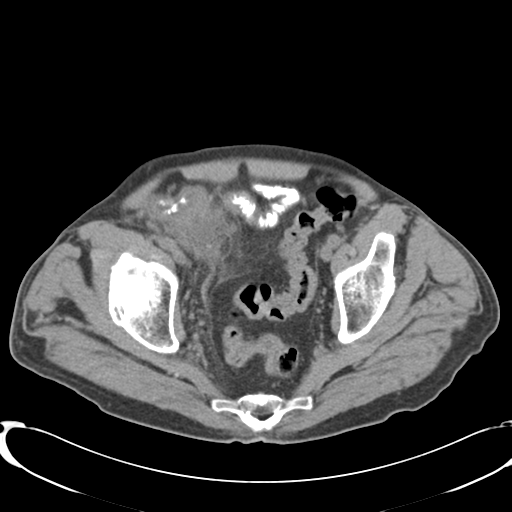 File:Appendiceal abscesses (Radiopaedia 50999-56542 Axial non-contrast 71).png