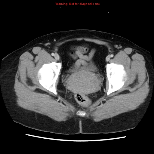 Appendiceal mucinous cystadenoma (Radiopaedia 8263-9111 Axial liver window 75).jpg