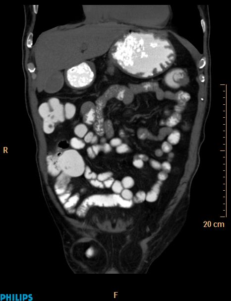 Appendiceal mucocoele (Radiopaedia 29449-29917 E 43).jpg