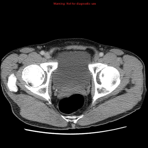 File:Appendicitis and renal cell carcinoma (Radiopaedia 17063-16760 A 54).jpg