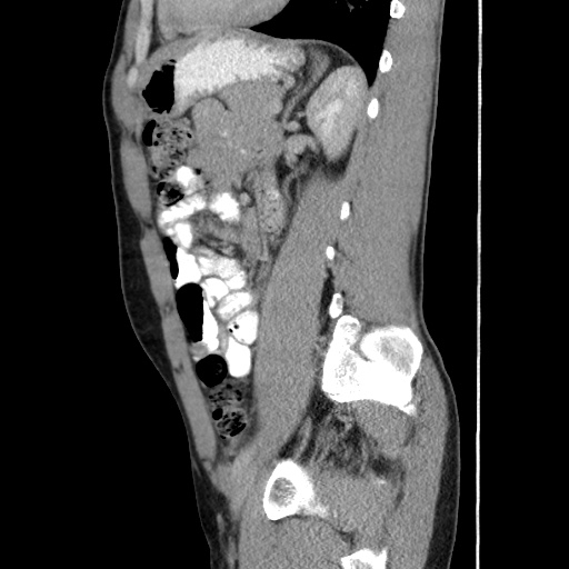 Appendicitis complicated by post-operative collection (Radiopaedia 35595-37114 C 48).jpg