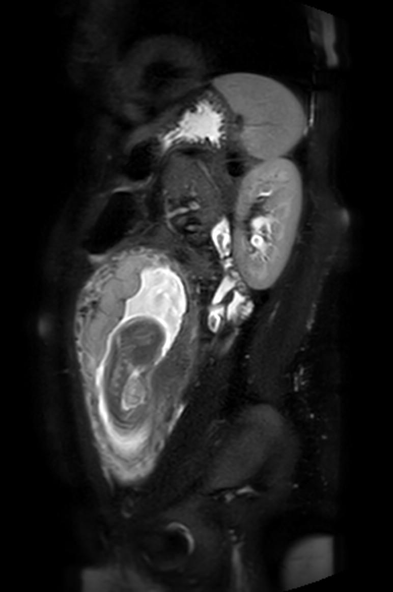 Appendicitis in gravida (MRI) (Radiopaedia 89433-106395 Sagittal T2 SPAIR 19).jpg