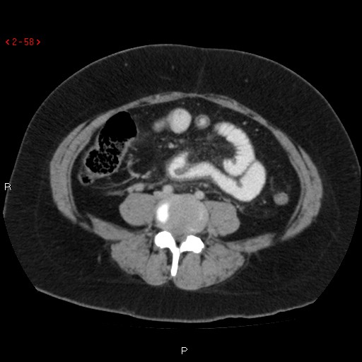 File:Appendicitis with microperforation- promontoric type (Radiopaedia 27268-27442 C 46).jpg