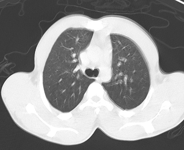 File:Arrow injury to the chest (Radiopaedia 75223-86321 Axial lung window 18).jpg