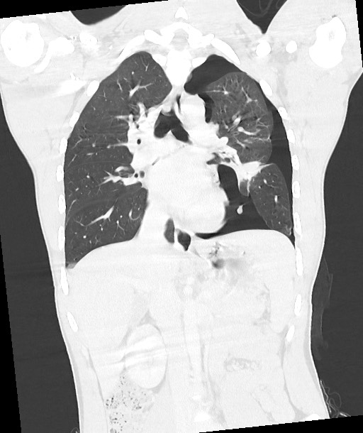 Arrow injury to the chest (Radiopaedia 85367-100975 Coronal lung window 77).jpg