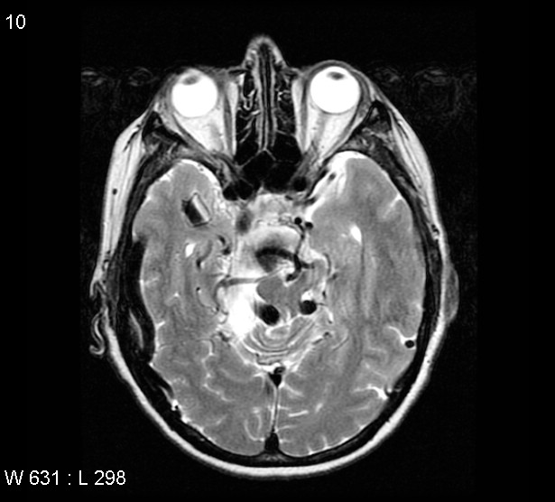 File:Arteriovenous malformation - cerebral (Radiopaedia 4000-6538 Axial T2 4).jpg