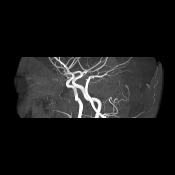 File:Artery of Percheron infarct (Radiopaedia 40966-43676 G 52).jpg
