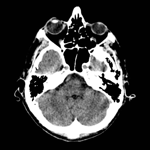 File:Artery of Percheron infarct (Radiopaedia 48088-52893 Axial non-contrast 8).jpg