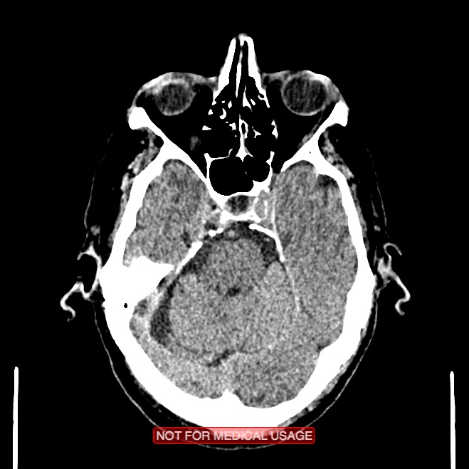 Artery of Percheron infarction (Radiopaedia 28679-28967 Axial non-contrast 37).jpg