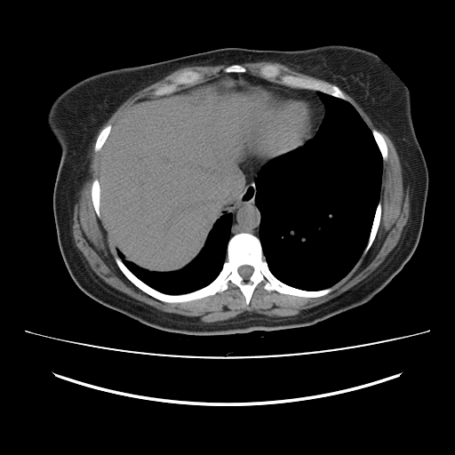 File:Ascending retrocecal appendicitis with liver abscesses (Radiopaedia 60066-67615 Axial non-contrast 9).jpg