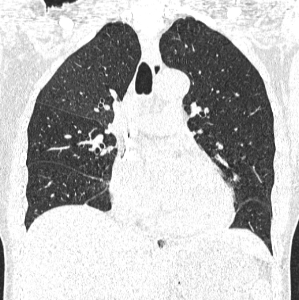 File:Aspergilloma (Radiopaedia 26223-26347 Coronal lung window 24).jpg