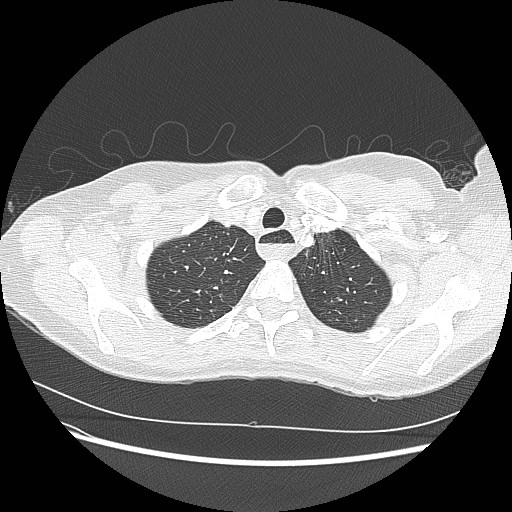 Aspiration pneumonia secondary to laparoscopic banding (Radiopaedia 18345-18183 lung window 12).jpg