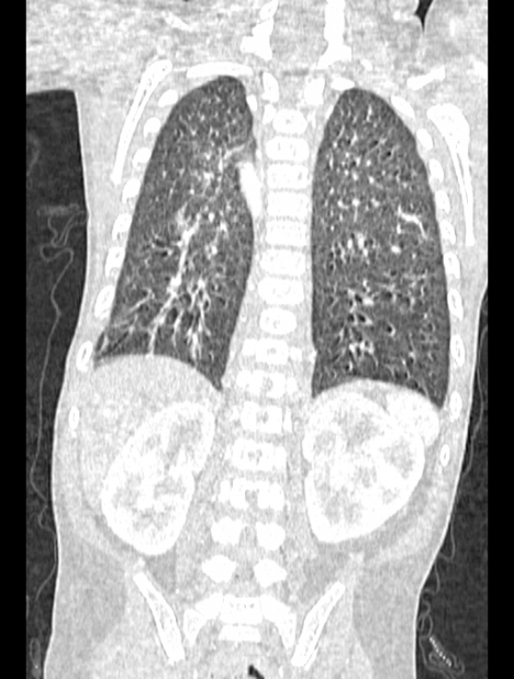 Asplenia syndrome (Radiopaedia 73083-83792 Coronal lung window 105).jpg