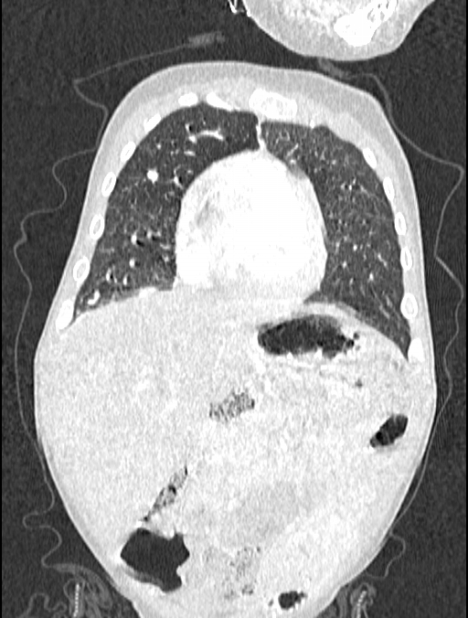 Asplenia syndrome (Radiopaedia 73083-83792 Coronal lung window 33).jpg