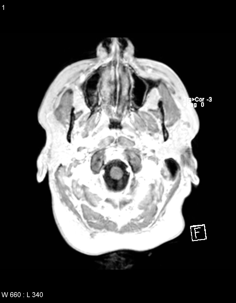 Astroblastoma (Radiopaedia 39792-42218 Axial T1 C+ 51).jpg