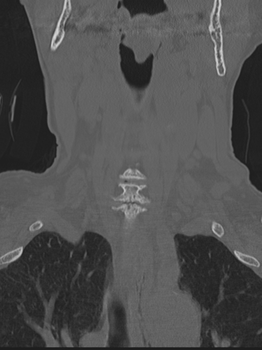 Atlanto-axial subluxation (Radiopaedia 36610-38176 Coronal bone window 12).png