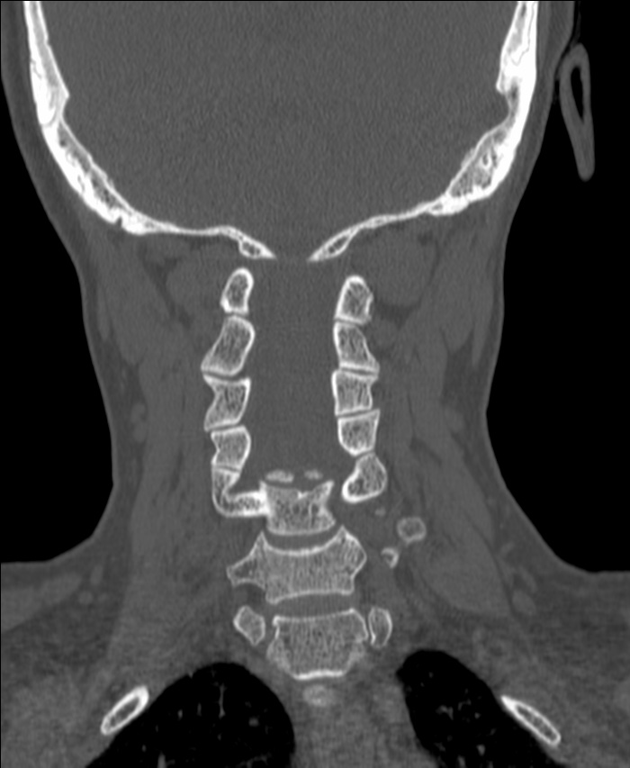 Atlanto-occipital assimilation with basilar invagination (Radiopaedia 70122-80188 Coronal bone window 133).jpg