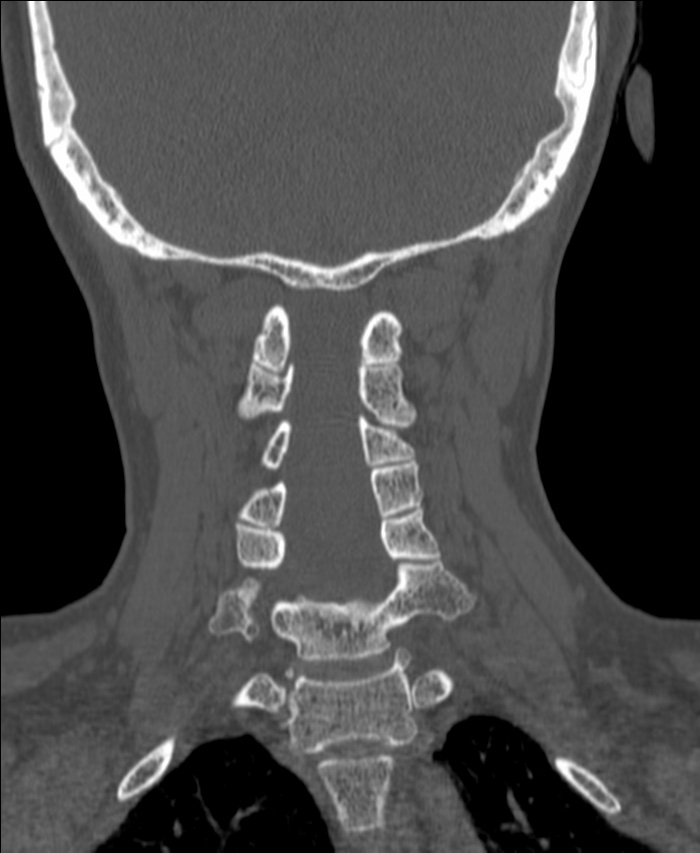 Atlanto-occipital assimilation with basilar invagination (Radiopaedia 70122-80188 Coronal bone window 143).jpg