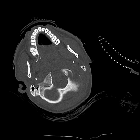 Atlanto-occipital dissociation (Traynelis type 1), C2 teardrop fracture, C6-7 facet joint dislocation (Radiopaedia 87655-104061 Axial bone window 15).jpg