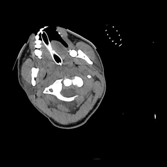 File:Atlanto-occipital dissociation (Traynelis type 1), C2 teardrop fracture, C6-7 facet joint dislocation (Radiopaedia 87655-104061 Axial non-contrast 17).jpg