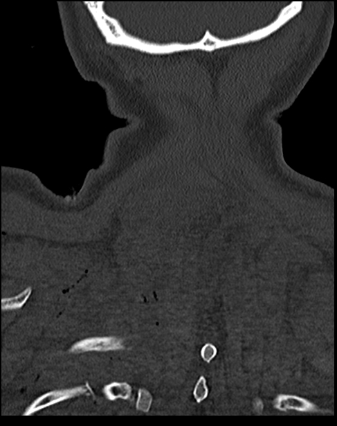 Atlanto-occipital dissociation - Traynelis type 1 (Radiopaedia 87570-103948 Coronal bone window 55).jpg
