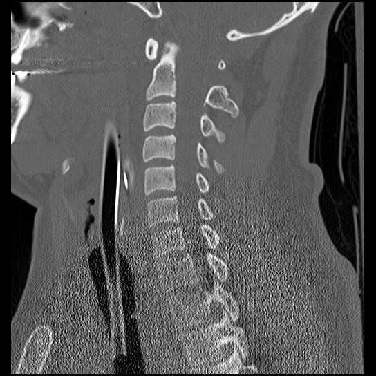 Atlanto-occipital dissociation injury (Radiopaedia 29274-29698 Sagittal bone window 29).png