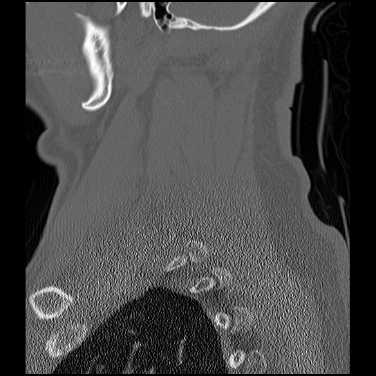 File:Atlanto-occipital dissociation injury (Radiopaedia 29274-29698 Sagittal bone window 49).png