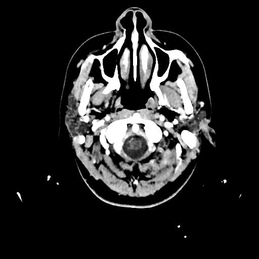 Atretic cephalocele (Radiopaedia 89782-106881 Axial with contrast 12).jpg